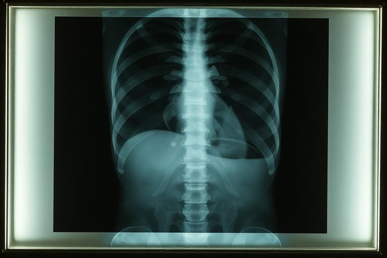 Raio-X Abdominal